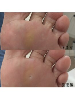 なかやまネイルクリニック/魚の目