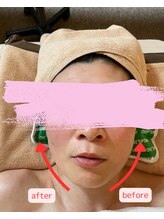 アロナ(ARONA)/ハンドセラピスでリフトアップ