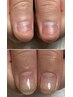 【自爪コンプレックス解消】深爪矯正★自爪育成で噛み癖なども解消