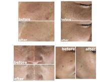 シミケア/ビフォーアフター