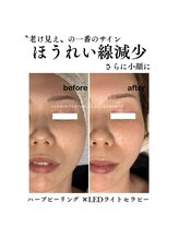 成宮鍼灸整骨院/ビフォーアフター（ほうれい線）