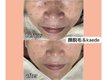 ベルミーランド 浜松天王/フェイシャルBefore→After