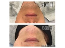 レイモード(Ray mode)の雰囲気(痛みが少ない×最速脱毛♪髭脱毛爆抜けモードつるすべ肌!)