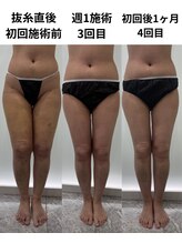 ダウンタイムオンニ(DowntimeOnni)/インディバ施術経過