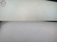 ヴィオール 名古屋栄店(VIOR)/【レデイース脱毛】　太もも　