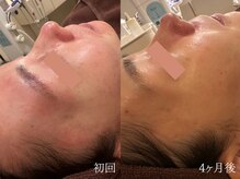 ウォーム(warm)/肌質改善/岡山/フェイシャル