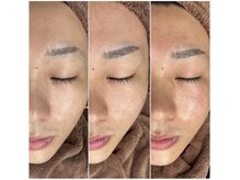 シエル ブルー(Ciel Blue)/肌質改善