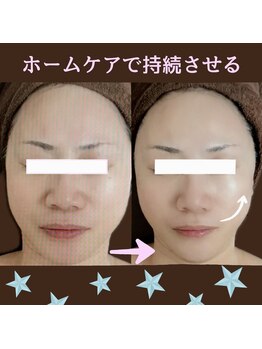 メディカルサロン かとれあ/小顔、リフト