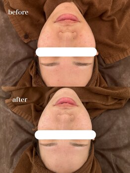 オアシス カナヤマ(Oasis kanayama)/【復元磁気ピーリング】