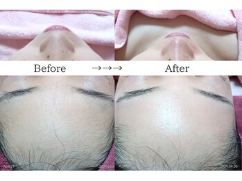 ココロ(COCORO)/(施術前後)シルクエピレーション