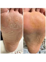 クク(KUKU)/大人気☆角質ケアメニュー