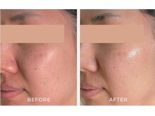 デラッセ サロン ギンザ 藤枝店(Delasser salon GINZA)/韓国いLLONうるツヤ水光肌