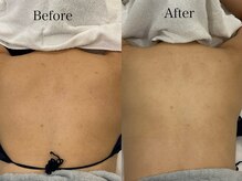 リフコウベ(LIF KOBE)/背中ハーブピーリング１回