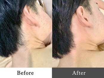 メンズオージー 岡山中区(men's O.G)/メンズ脱毛|襟足脱毛