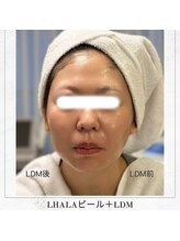 アマテラススキンラウンジ(Amatelas SKIN LOUNGE)/LHALAピール＋LDM