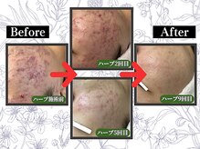 ポーベルポー(Peau Belle poe)/無添加ハーブピーリング(9回目)