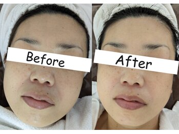 マインドール/むくみ・ たるみケアで小顔