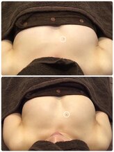 美人バスト 本厚木店/バストアップ◇症例◇