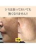 【2回目以降のお客様】シミケア当て放題20分