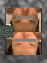 チョンダムビューティー(chondam beauty)/毛穴の開き・詰まりにハーブの力