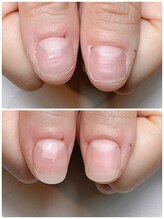 スマイルニコ(smile nico)/自爪風深爪矯正