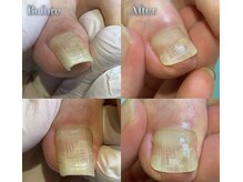 仙台巻き爪補正店/【巻き爪補正】