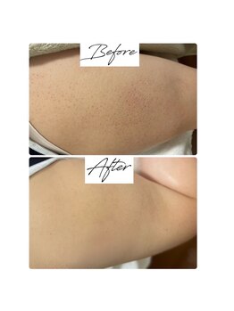 ビズビズ 梅田店(bisebise)/毛穴のブツブツ/沈着も改善