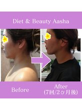 ダイエット アンド ビューティー アーシャ(Diet & Beauty Aasha)/ビーナスフェイシャル施術例