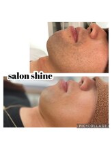 サロンシャイン(Salon Shine)/メンズヒゲ脱毛１１回目