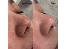 ココ(Coco)/毛穴洗浄1回