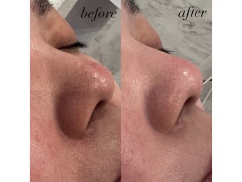 ココ(Coco)/毛穴洗浄1回