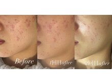 ベルバーチュプラス(Belle Virtue +)/カーボキシー&ハーブ