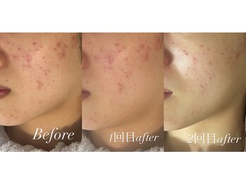 ベルバーチュプラス(Belle Virtue +)/カーボキシー&ハーブ