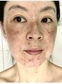 福岡美人工房 アロマムーン 酷いニキビと色素沈着さらにシミが出て汚肌に悩み続けた私だから