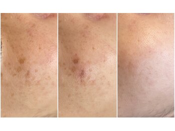 ベルエクラ(Bel Eclat)/シミ改善☆毛穴/那覇