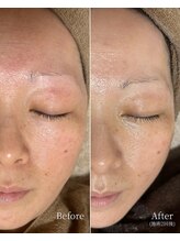 エース(ACE.)/【赤ら顔・シワ】を改善！