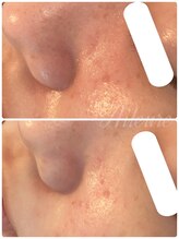 エルール トータルビューティ(Aileure total beauty)/最先端のVOSハーブピーリング