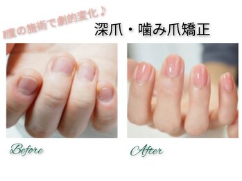 ミント(Mint)/人生変わる♪深 爪 矯 正☆