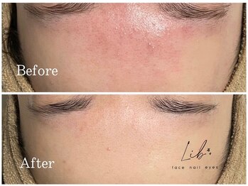 リブ(Lib)/天然素材本格ハーブピーリング