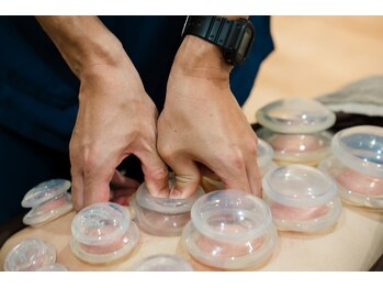 たたら鍼灸整骨院/カッピング