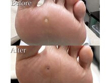 仙台巻き爪補正店/【【硬いタコ/魚の目ケア】