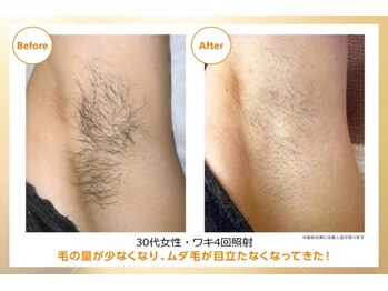 オワゾーブルー(Oiseaubleu)/30代/光脱毛4回照射