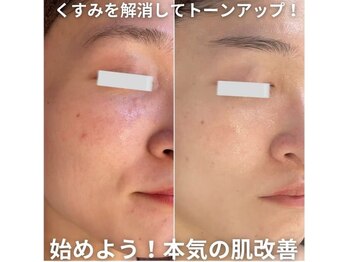 ファシル(Facile)/肌質改善