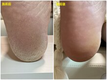 フットケアリストシュウ(footcarelist shu)/施術【かかとカサカサ角質ケア】