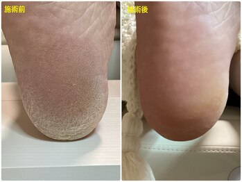 フットケアリストシュウ(footcarelist shu)/施術【かかとカサカサ角質ケア】
