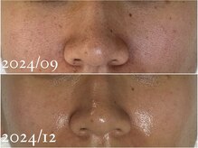 フォー(For...)/肌質改善・毛穴ケア◇ララピール