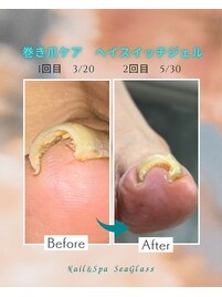 巻き爪ケア2回目