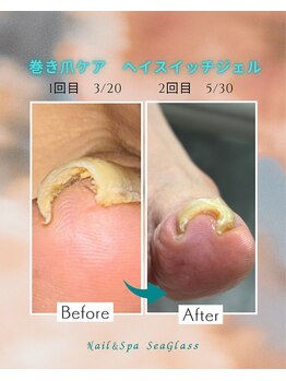 シーグラス(SeaGlass)/巻き爪ケア2回目