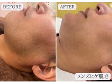 ルミア 函館店(LuMia)/毎朝のヒゲ剃り、もう不要！