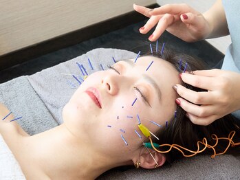 ソエルテ/小顔&リフトUPを美容鍼で!!